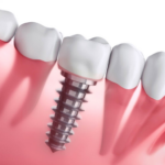 dental implants