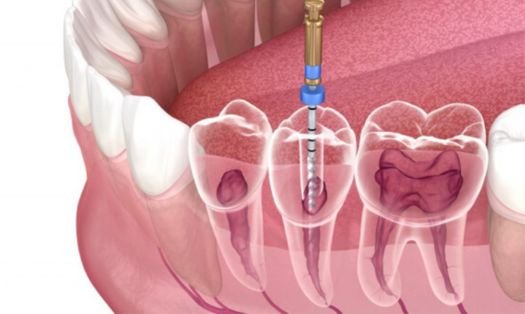 Root Canal