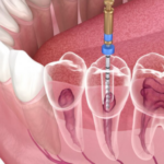 Root Canal